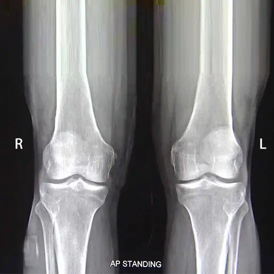 Both Knee X-ray AP View